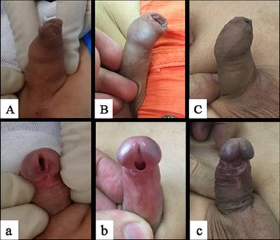 Diagnosis and Treatment of Hypospadias With Megameatus Intact Prepuce